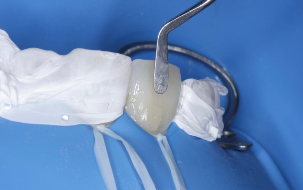 Imagen ilustrativa del artículo Adhesión dental inteligente