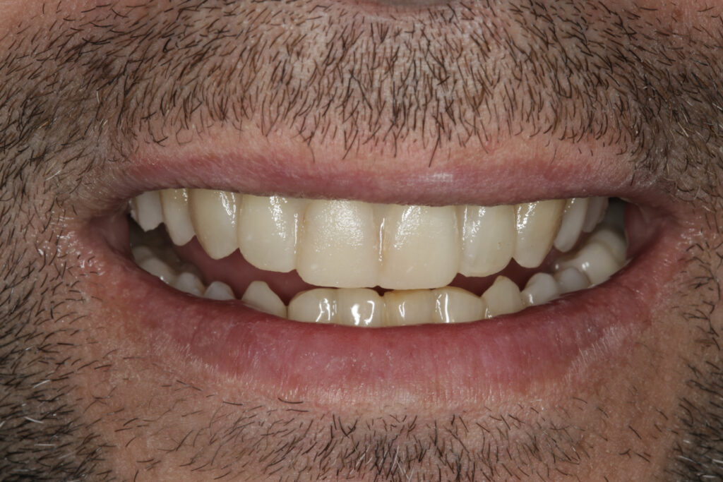Ortodoncia Invisalign sin terminar — galería 1.1