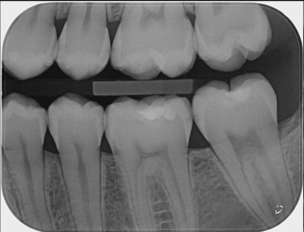 Imagen ilustrativa del artículo Q+A, Caries
