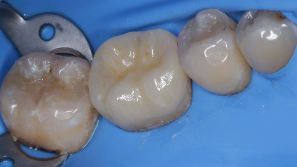 Imagen ilustrativa del artículo Adhesión dental inteligente