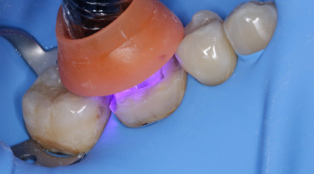 Imagen ilustrativa del artículo Adhesión dental inteligente