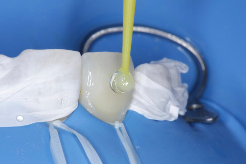Adhesión dental inteligente