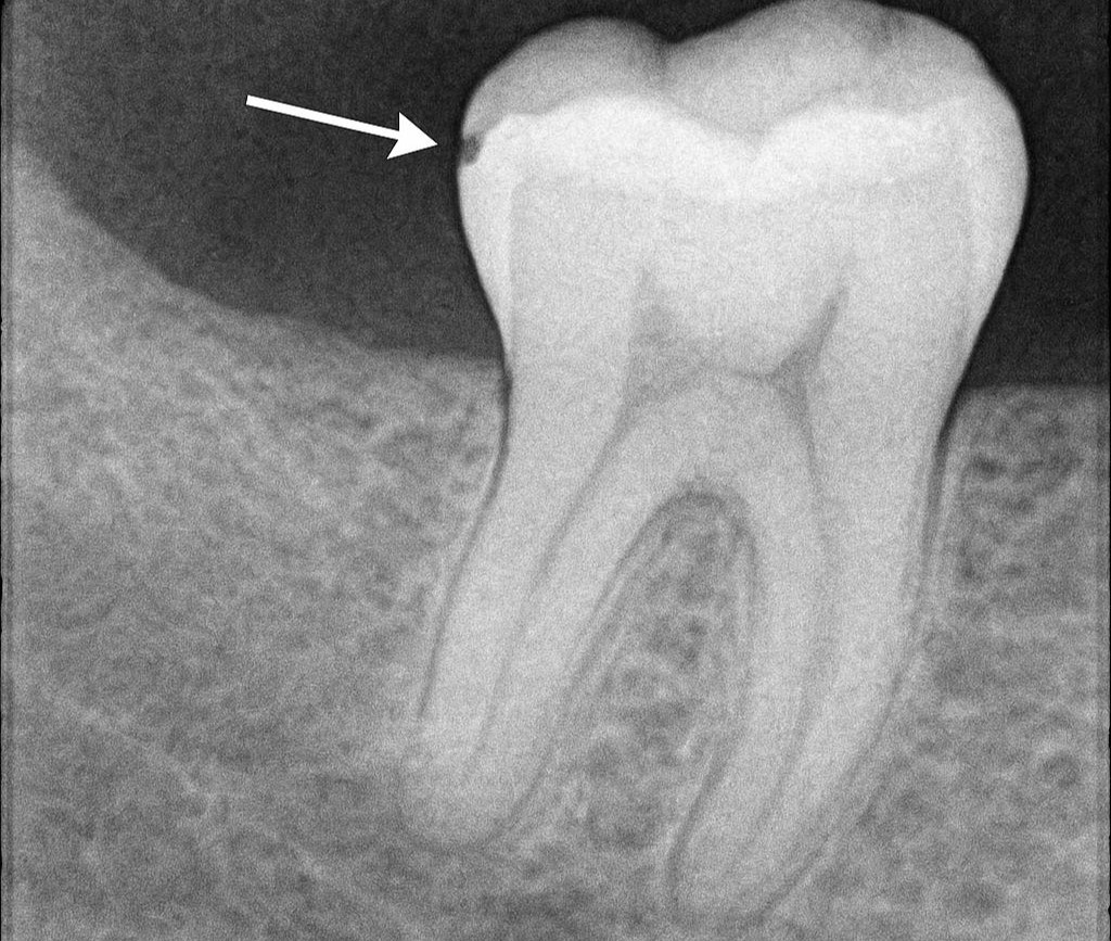 Imagen ilustrativa del artículo Q+A, Caries