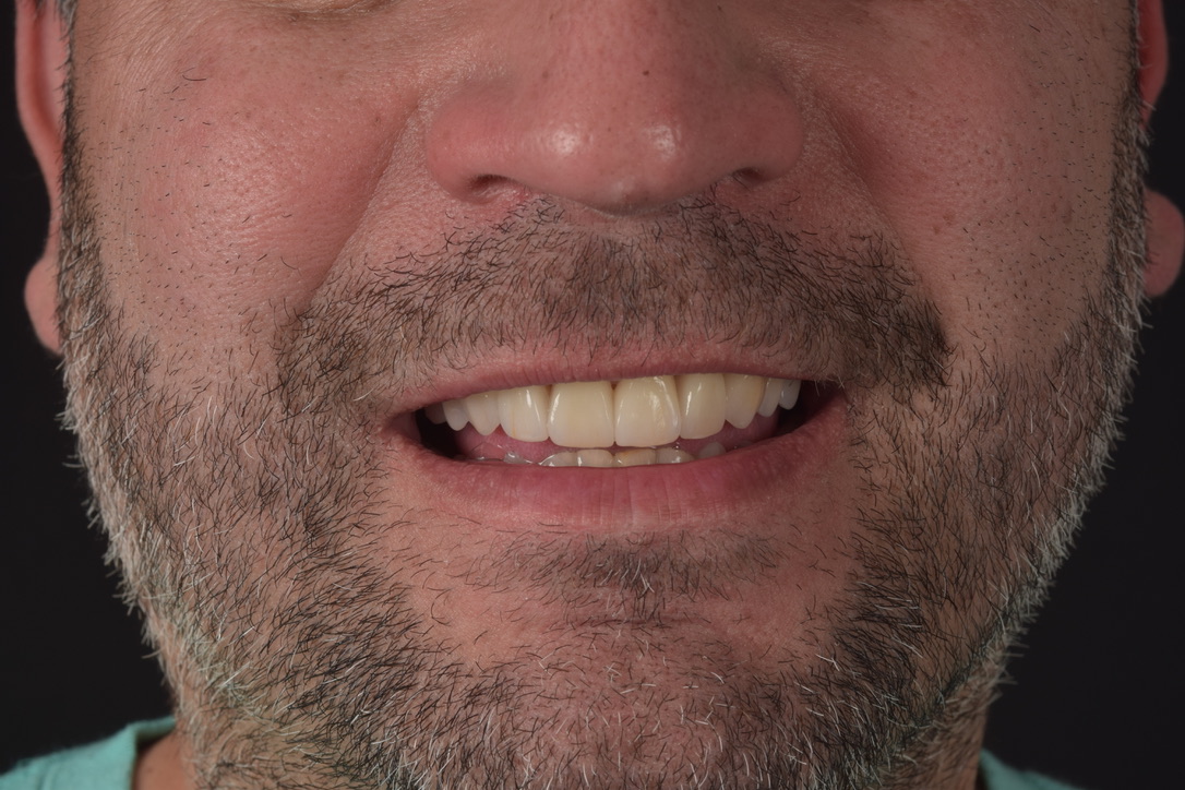 Ortodoncia Invisalign sin terminar