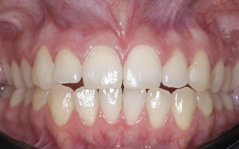 Imagen ilustrativa del artículo Adhesión dental inteligente