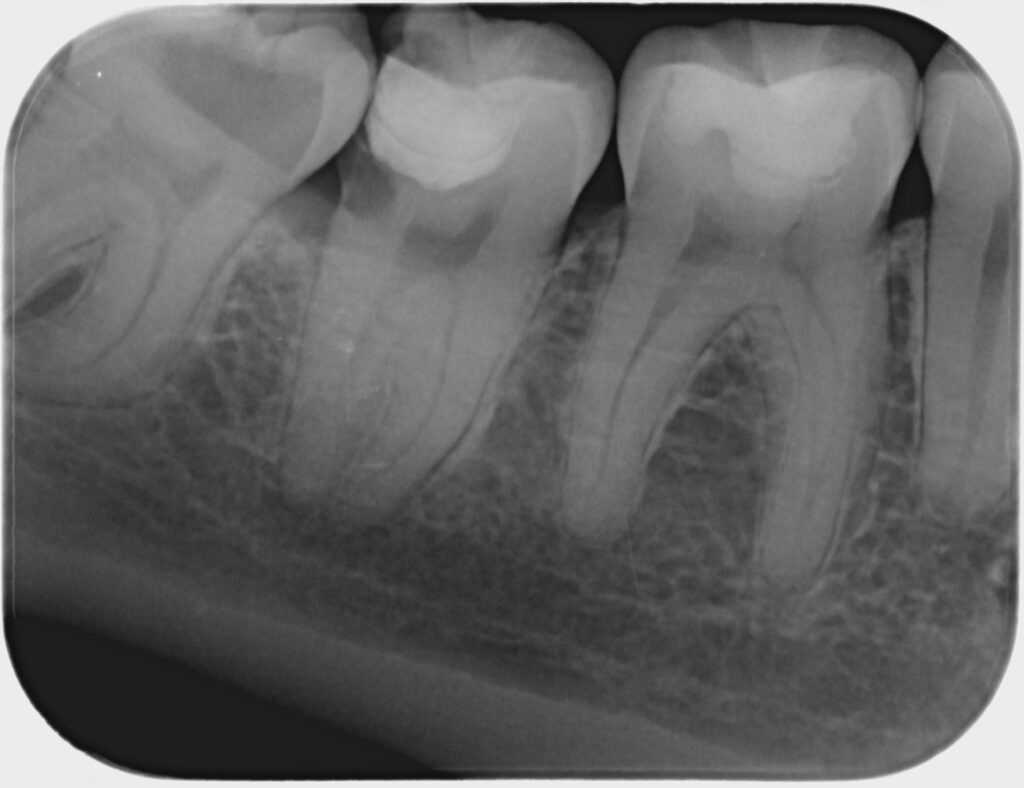 Imagen ilustrativa del artículo Q+A, Caries
