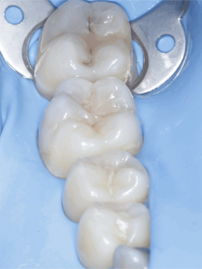 Imagen ilustrativa del artículo Q+A, Caries