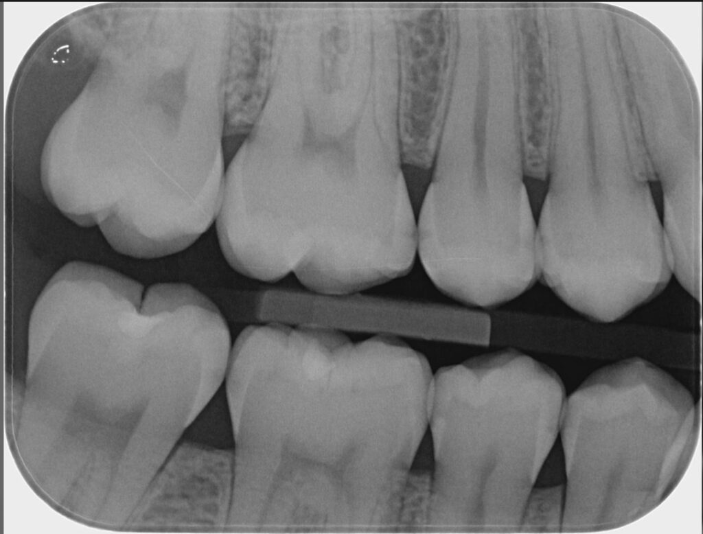 Imagen ilustrativa del artículo Q+A, Caries