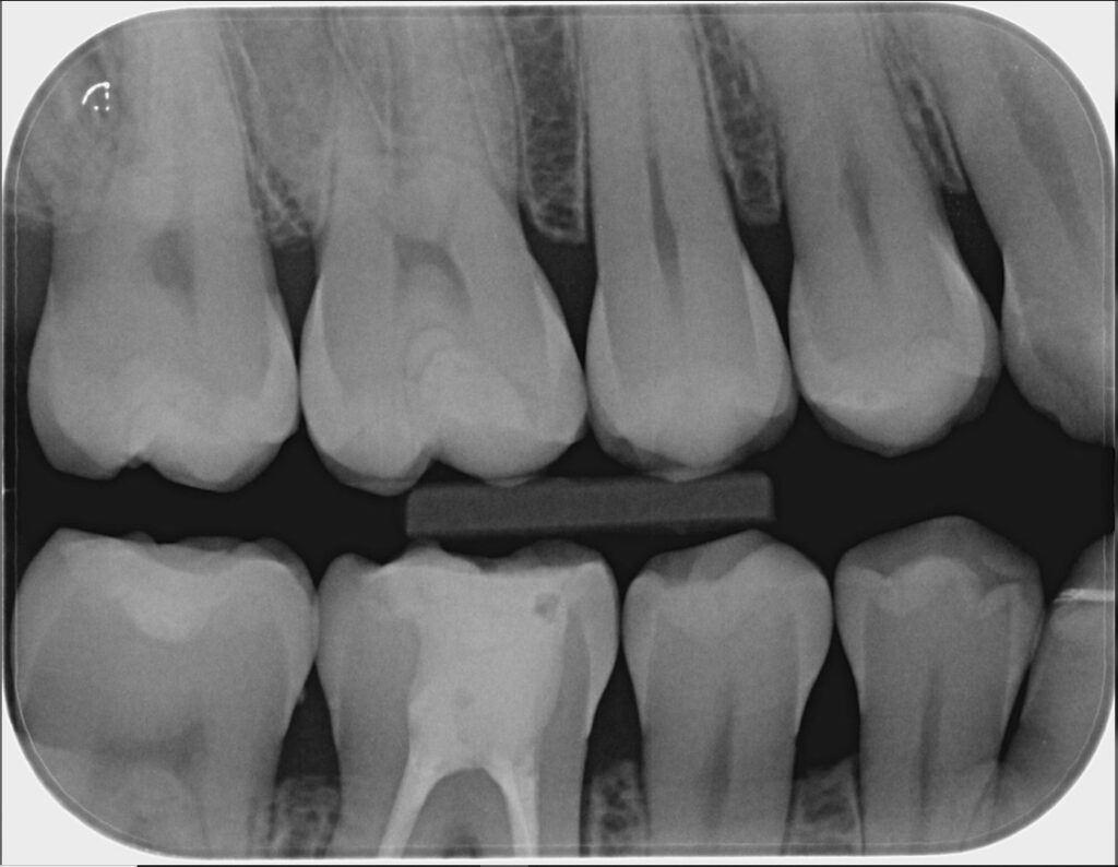 Imagen ilustrativa del artículo Q+A, Caries