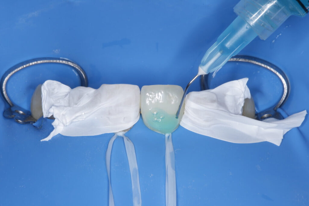 Imagen ilustrativa del artículo Adhesión dental inteligente