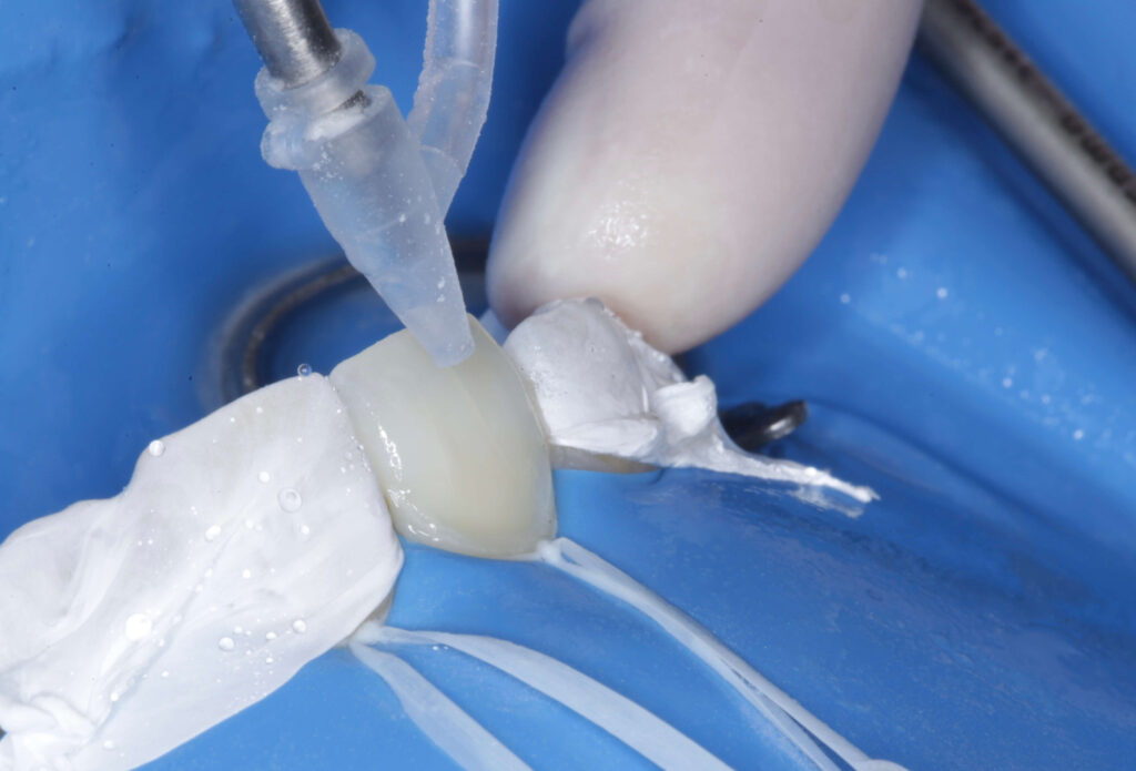 Imagen ilustrativa del artículo Adhesión dental inteligente