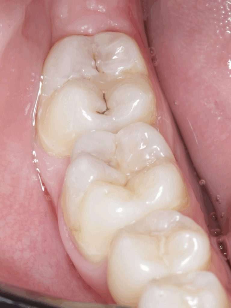 Imagen ilustrativa del artículo Q+A, Caries