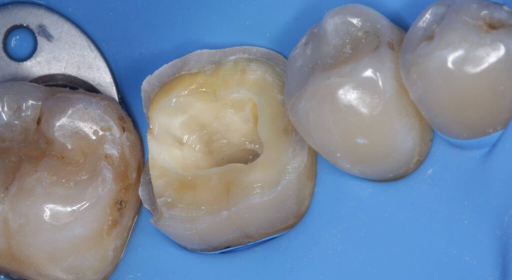 Imagen ilustrativa del artículo Adhesión dental inteligente