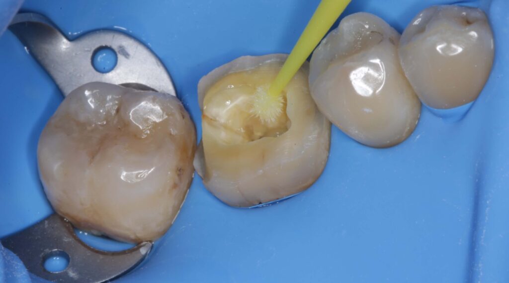 Imagen ilustrativa del artículo Adhesión dental inteligente