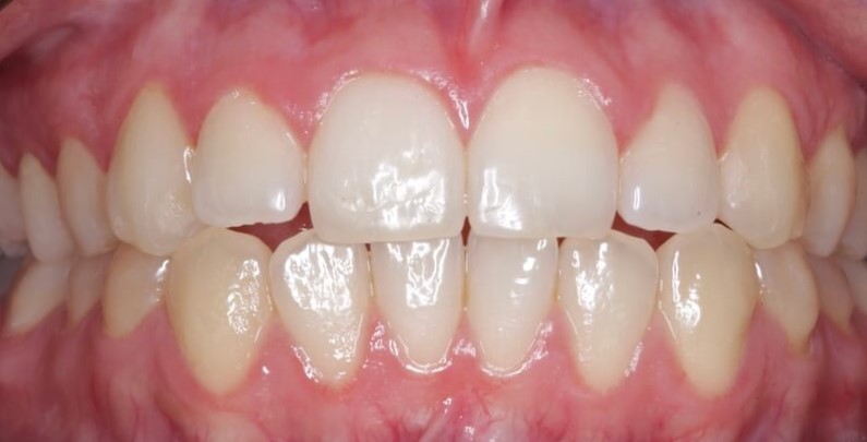 Imagen ilustrativa del artículo Adhesión dental inteligente