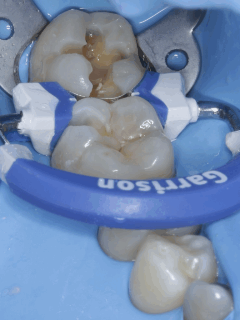 Imagen ilustrativa del artículo Q+A, Caries