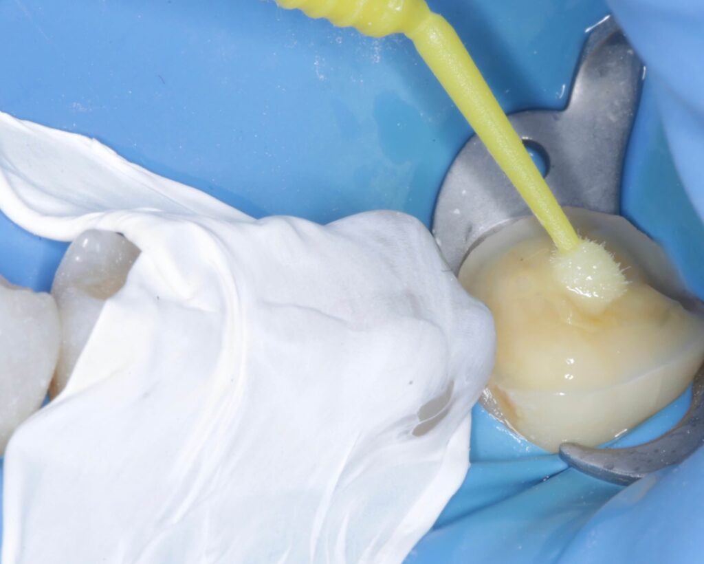 Imagen ilustrativa del artículo Adhesión dental: mucho más que un pegamento