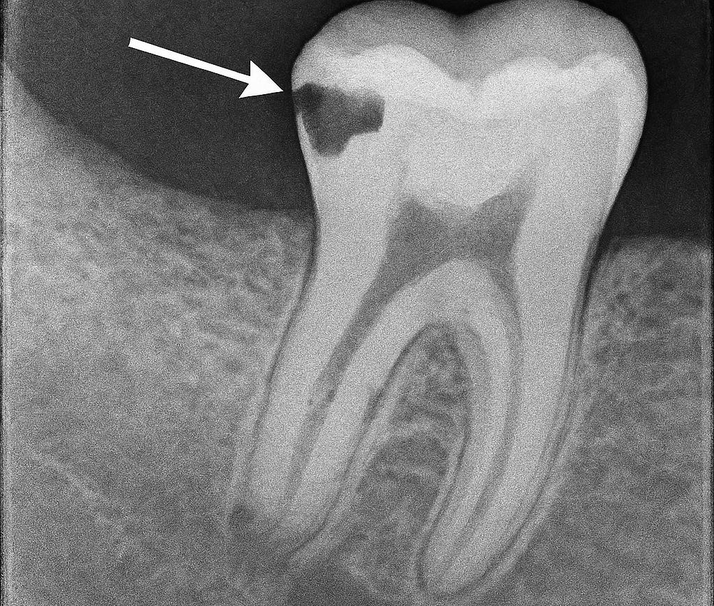 Imagen ilustrativa del artículo Q+A, Caries