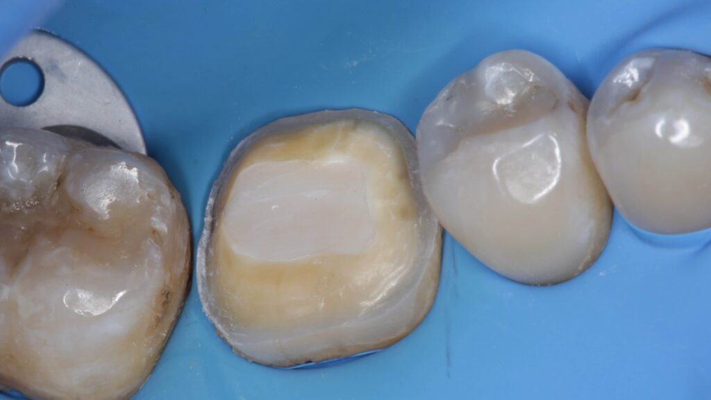 Imagen ilustrativa del artículo Adhesión dental inteligente