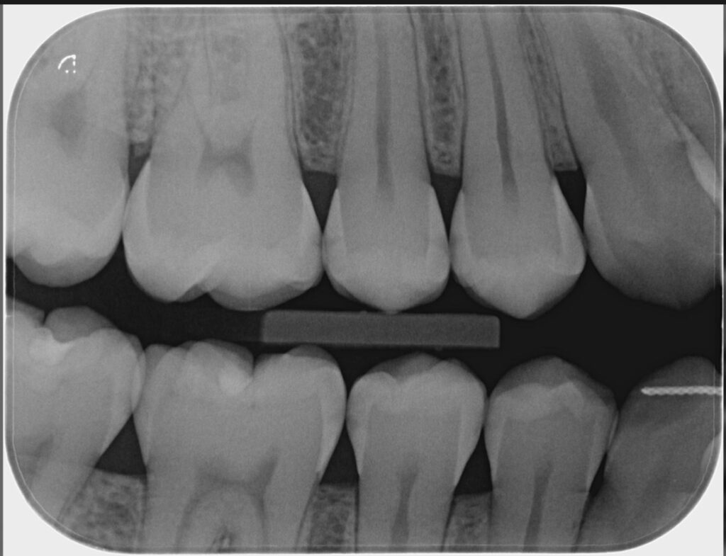 Imagen ilustrativa del artículo Q+A, Caries